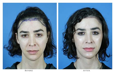 However, hair loss in women can be treated much more easily, as it is generally caused by temporary health problems. Patient 1720 Transgender Hair Restoration Before and After ...