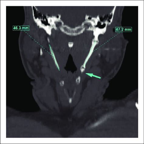 Computed Tomography Scan Of The Neck In Soft Tissue Window Figure 1a