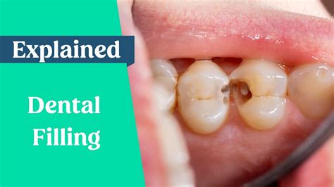 Dental Fillings Explained Youtube