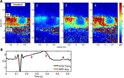 Intracardiac Acoustic Radiation Force Impulse Imaging A Novel Imaging