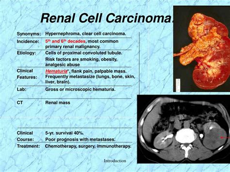 Kidney Renal Cell Cancer Pictures