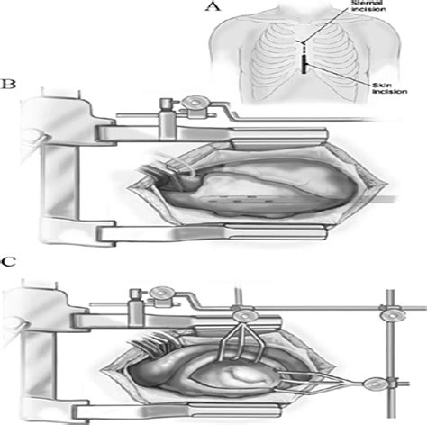 Minimally Invasive Valve Surgery Cardiology In Review