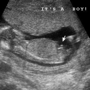Watch this interactive video to learn your baby's development and your. Early Gender Boys 14 Weeks | 3D 4D HD Ultrasound Virginia