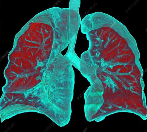 Normal Lungs Ct Scan Stock Image C0166691 Science Photo Library