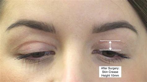 Cosmetic Eyelid Surgery And Blepharoplasty Surgery For The Young