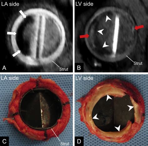 Subvalvular Pannus And Thrombosis In A Mitral Valve Prosthesis