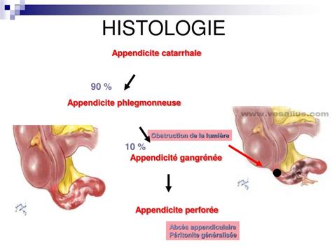 Appendicite perforata, appendicite grave operata in ritardo, devo stare con le gambe piegate, non riesco a fare aria, ho la febbre, come si scopre se ho l'appendicite. PPT - Appendicite Aiguë PowerPoint Presentation - ID:5563234