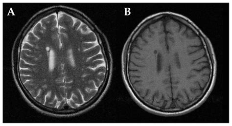 May 11, 2021 · multiple sclerosis is a chronic condition of the central nervous system. MRI in multiple sclerosis: a hyperintense parietal white ...