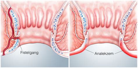 Dies verursacht dann die typischen symptome eines hämorrhoidalleidens. Analabszesse und -Fisteln - EDZ Main-Taunus