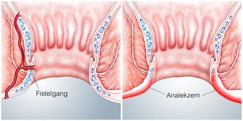Dabei handelt es sich um meist drei blutpolster, die kurz vor dem after sitzen. Analabszesse und -Fisteln - EDZ Main-Taunus