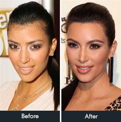 Grafting hair is the alternate procedure for hairline lowering. Hair Removal Archives | The Neiman Dermatology Building ...