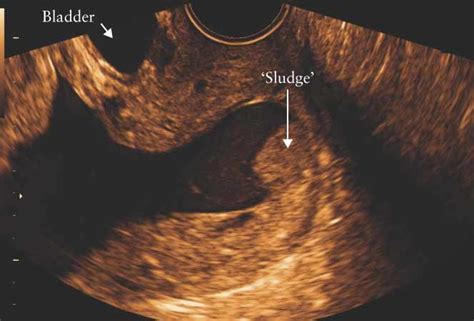 What Is Amniotic Fluid ‘sludge Romero 2007 Ultrasound In