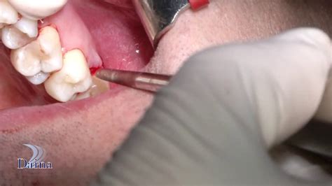 Quanto Costa Togliere Un Dente Dal Dentista Gianni Villa Ortodonzia