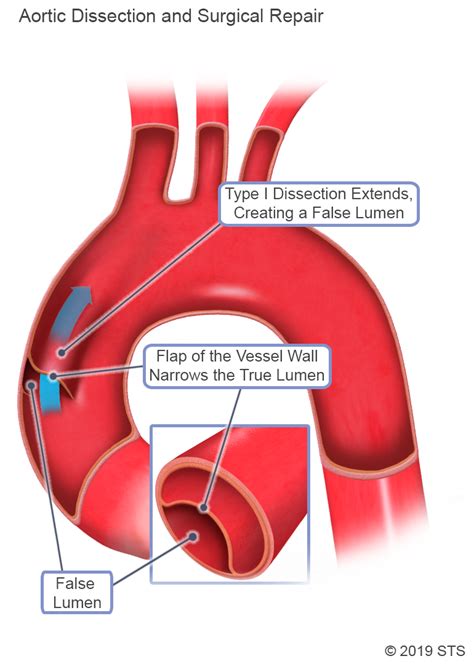 Aortic Dissection The Patient Guide To Heart Lung And Esophageal