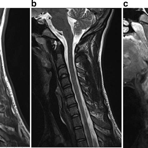 Mri With And Without Gadolinium Enhancement Axial Views Of Pd A