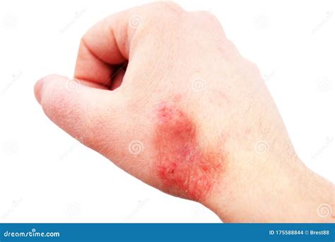 Atopic Dermatitis Ad Also Known As Atopic Eczema Is A Type Of