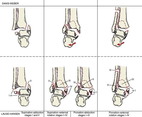 Ankle Fracture Weber And Lauge Hansen Classification