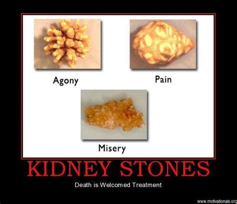 Here you can explore hq kidney stone transparent illustrations, icons and clipart with filter setting like size, type, color etc. Perguntas