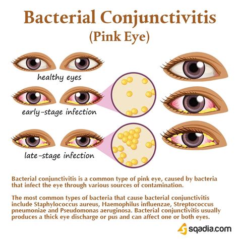 Bacterial Conjunctivitis Bacterial Pink Eye Pink Eye Antibiotics