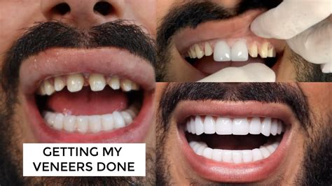 Do You Really Need To Get Your Teeth Shaved For Veneers The Teeth Blog