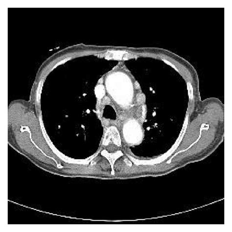 A A Chest Ct Shows Multiple Enlarged Lymph Nodes In Mediastinum B