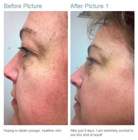 Kp Face Treatment Dorothee Padraig South West Skin Health Care