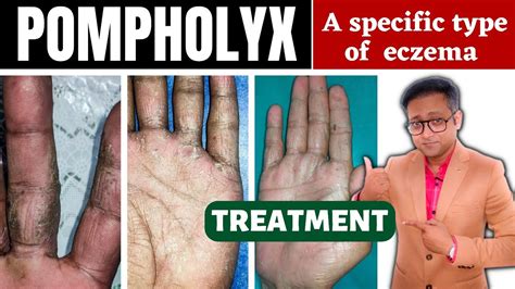 Dyshidrotic Eczema Pompholyx Treatment Hindi Youtube