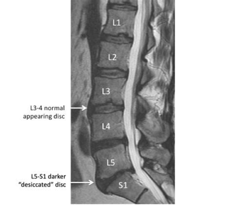 Understanding Your MRI Of The Lumbar Spine