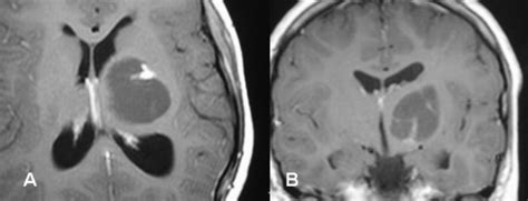 Mri Brain Showed Left Thalamic Postoperative Recurrent Cystic Pilocytic