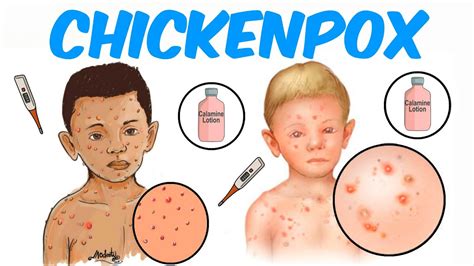 Chickenpox Youtube