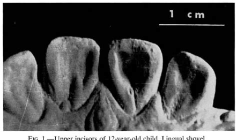 Figure 1 From Shovel Shaped Incisors In A Northwestern Argentine