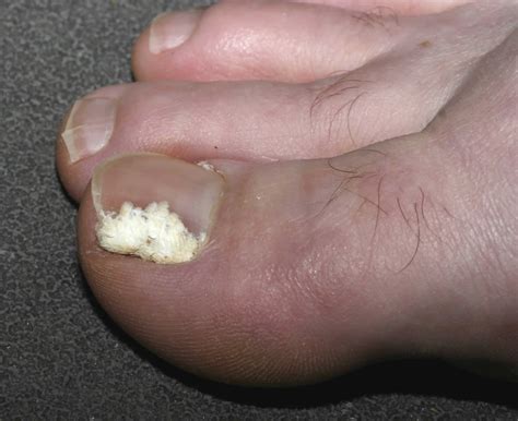Nail Fungus Infection Causes And How To Get Rid Of Nail Fungus Infection
