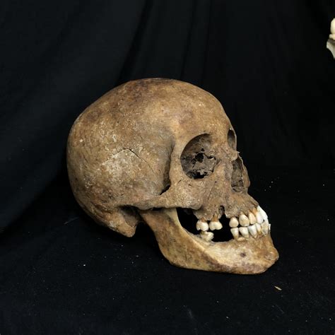 Sold Human Skull Reserved For Mysz Oddarticulations Llc