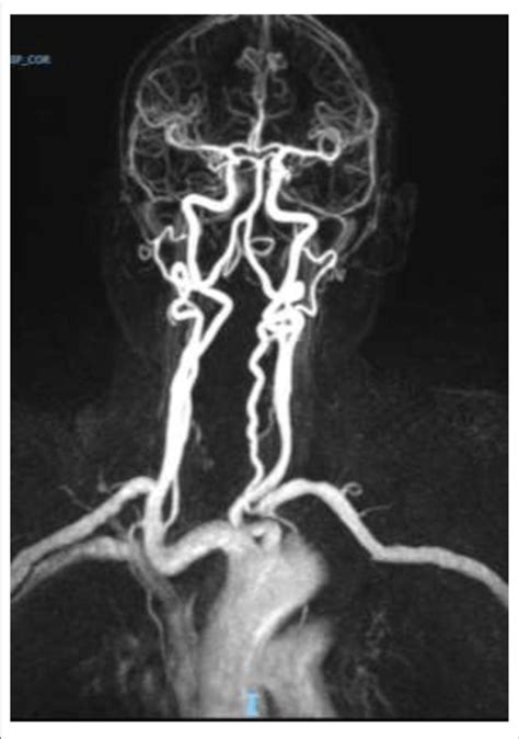 Normal Magnetic Resonance Mr Angiogram No Evidence Of Vasospasm In