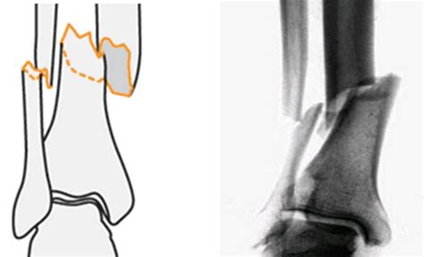 Fracture 42a23 Fibula Fractured At The Same Level These Are Simple