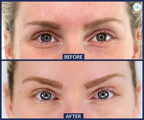 Skin Care Tips For Beautiful Skin | Botox face, Botox eyes, Eyebrow