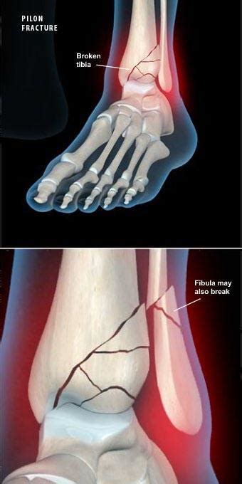 Pilon Fractures Sarasota Fl Schofield Hand And Bright Orthopaedics