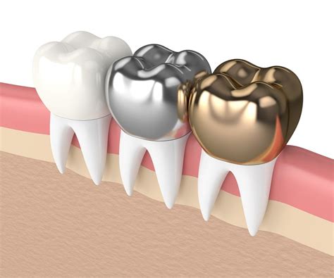 Dental Broken Tooth Repair In Bloomfield Hills Mi Scott J Owens Dds