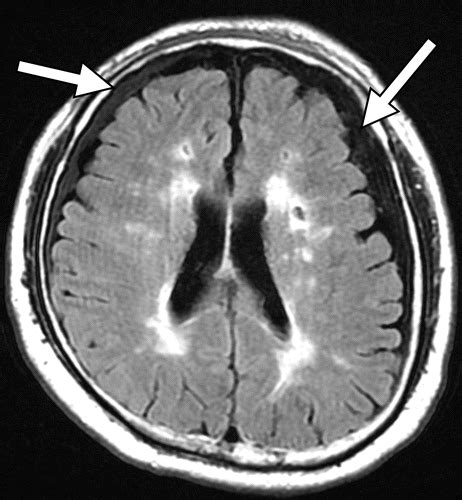 Traumatic Brain Injury Imaging Patterns And Complications Radiographics