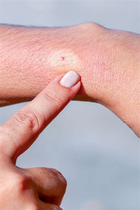 Bite On Foot With White Center Best Sale | emergencydentistry.com