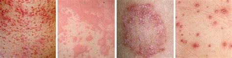 Spots On The Skin Rashes In Patches Causes And Treatment Health Care Qsota Tips And
