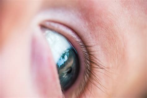 Ini Dia Deprivasi Amblyopia Mata Malas Yang Disebabkan Katarak Kasoem Vision Care