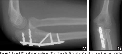 Figure 3 From Ulnar Fracture With Late Radial Head Dislocation Delayed