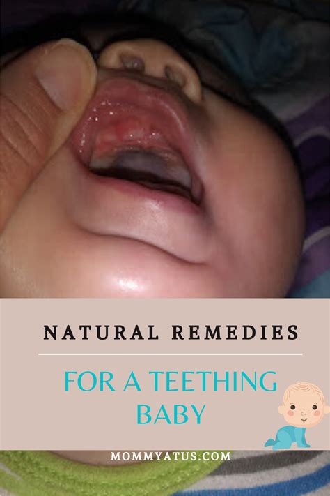 Natural Remedies For Teething Baby In 2020 Baby Teeth Baby Teething