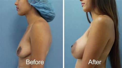 Dual Plane Breast B And After XHamster