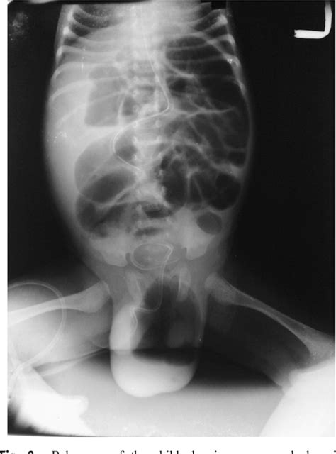 Figure 2 From Neonatal Incarcerated Inguinal Hernia With Spontaneous