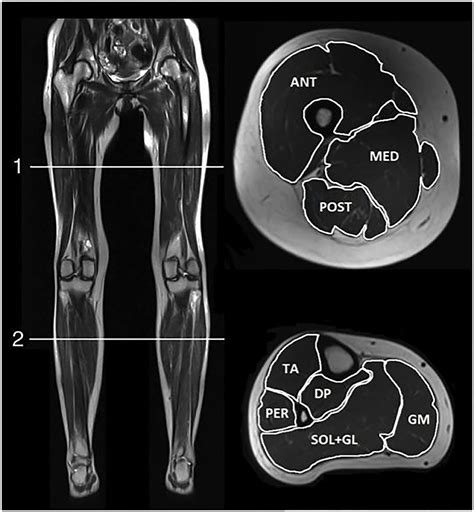 Frontiers Quantitative Muscle MRI And Clinical Findings In Women With