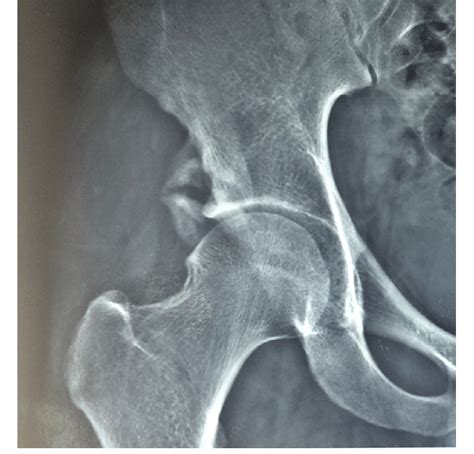 X Ray Of Right Hip Showing Avulsion Fracture Of Anterior Inferior Iliac