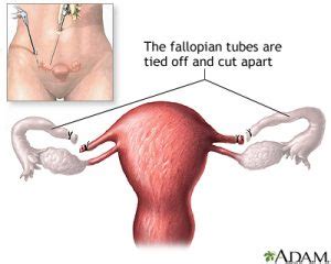 What Is A Tubal Ligation Tubal Ligations And The Difficulties Women