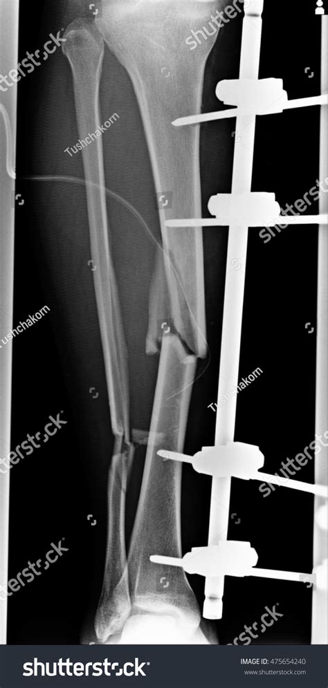 Xray Show Fracture Leg Tibia Fibular Stock Photo Edit Now 475654240